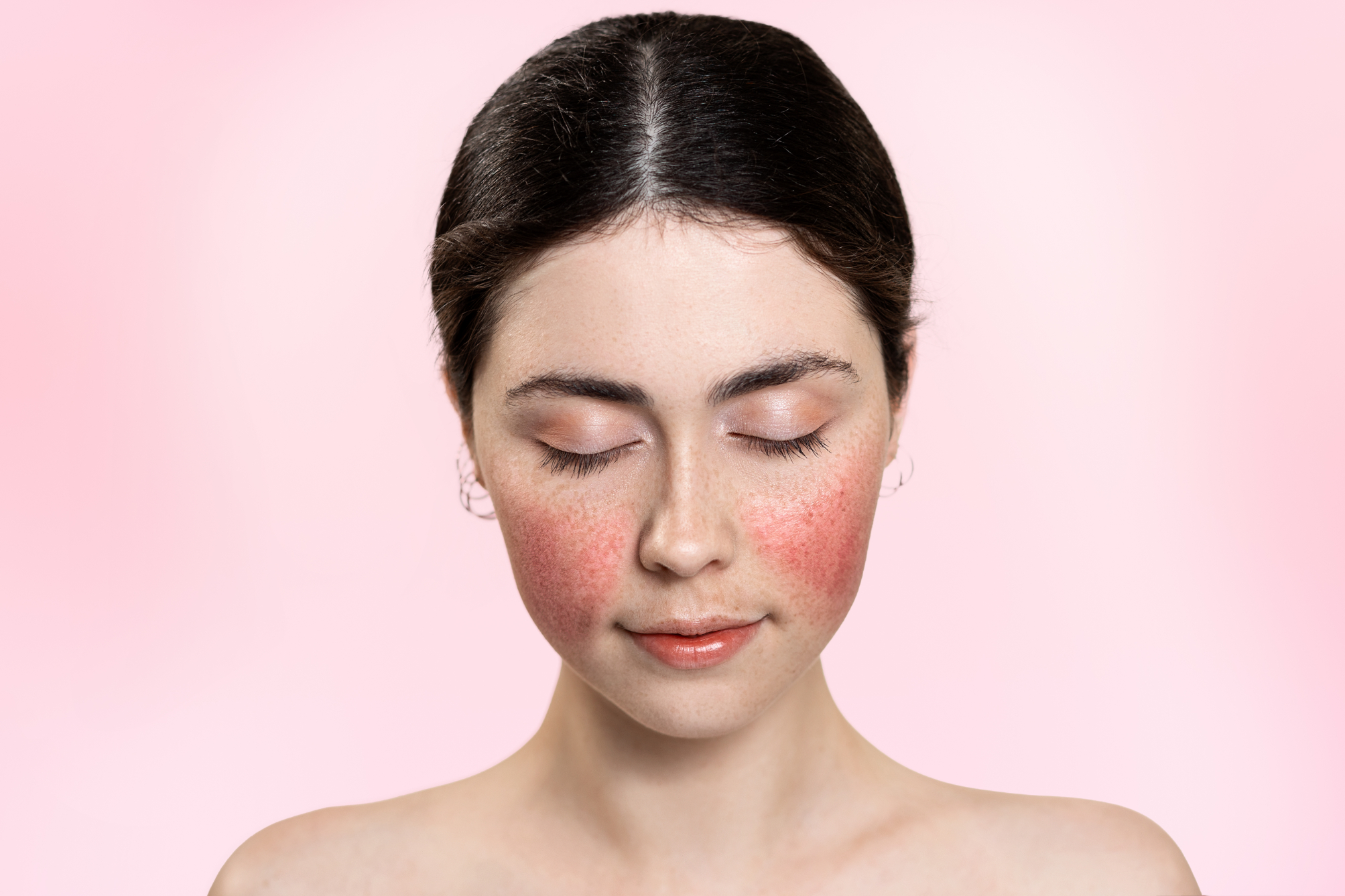 Rosacea - EF MEDISPA