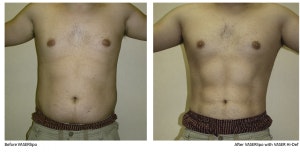 Vaser Liposuction