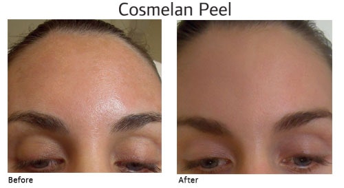 Cosmelan Peel