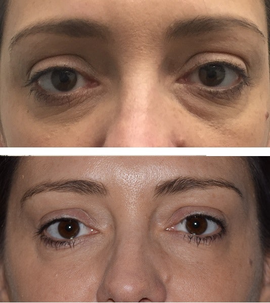 Tear Trough Dermal Filler Treatment Before and After