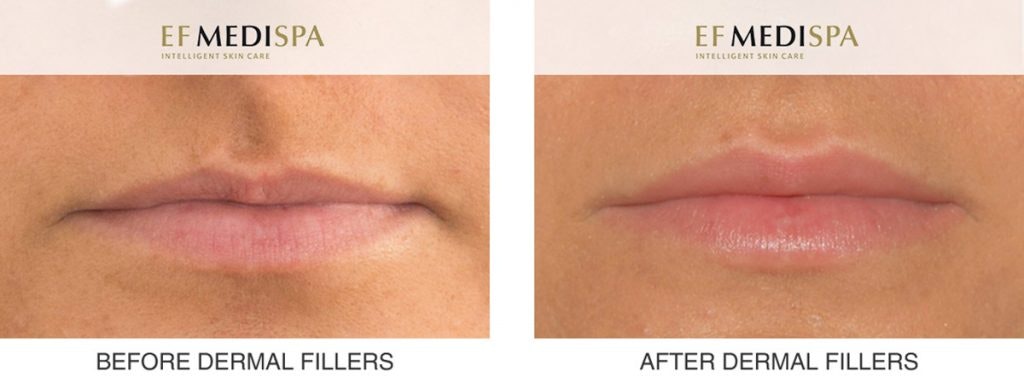 Before and After Dermal Fillers