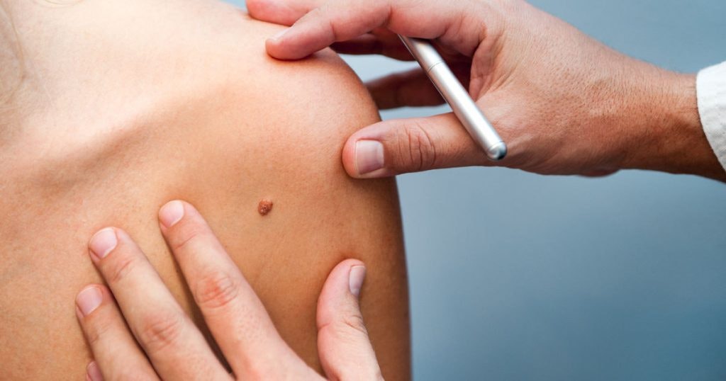 What Types of Mole Removal Are Available?