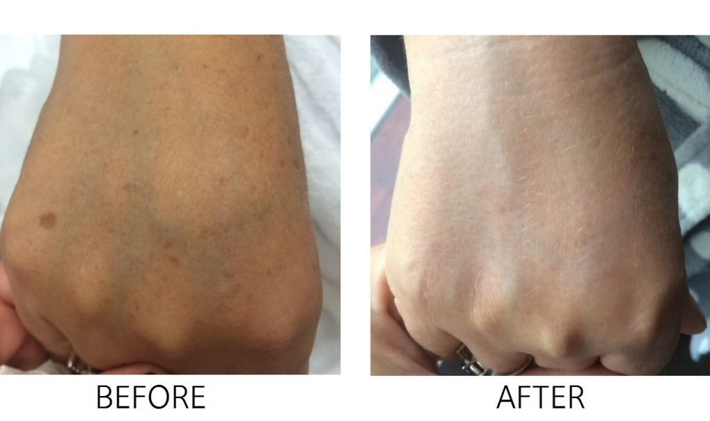 IPL pigmentation before & after