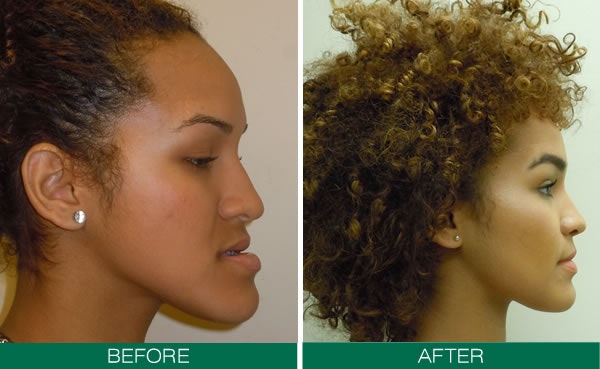  orthodontics fix female jaw