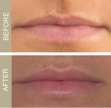 Anti-Wrinkle Injectables 