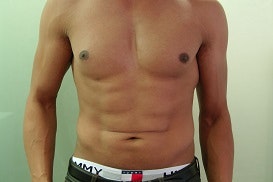 Vaser Liposuction
