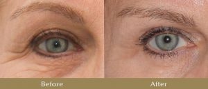 How Safe are Injections for the Face and Body