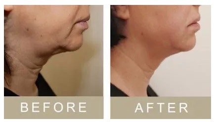 3D SkinLift by Ultraformer