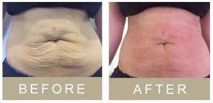 3D SkinLift by Ultraformer