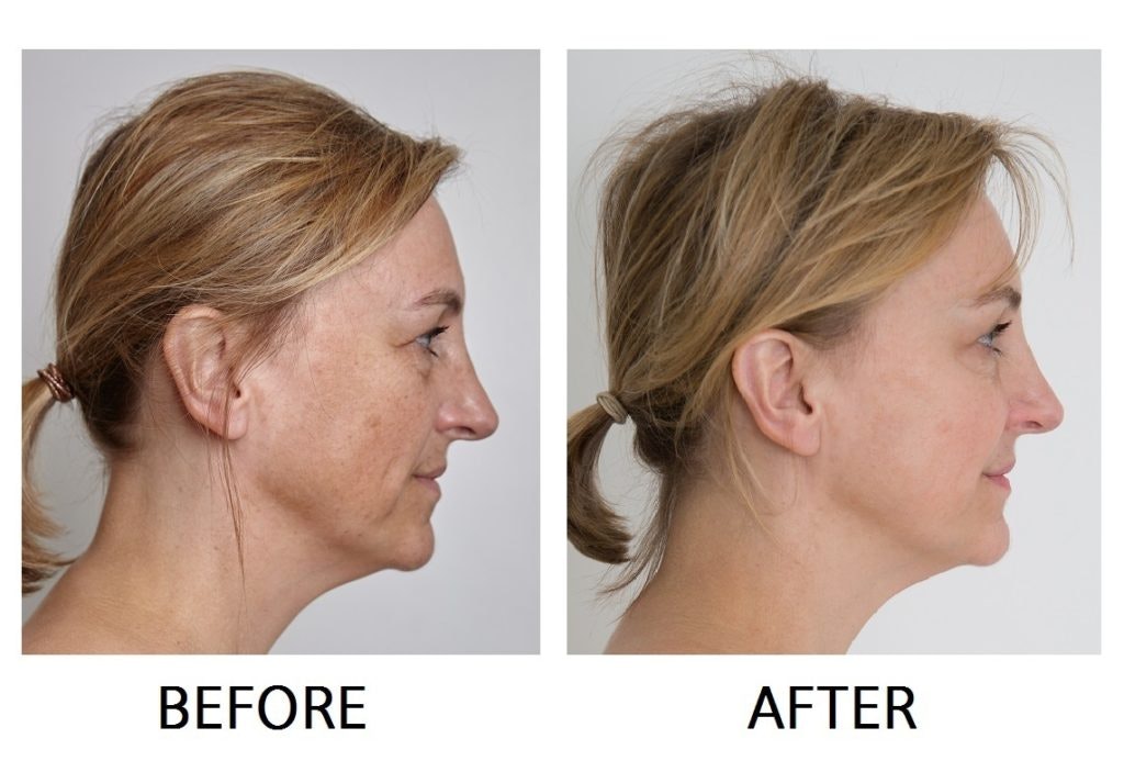 Pauline Facial Rejuvenation Side Before and After