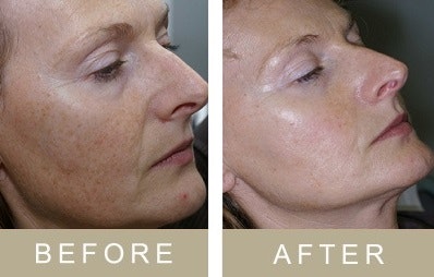 Pigmentation with Pixel