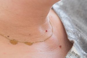 Skin tags