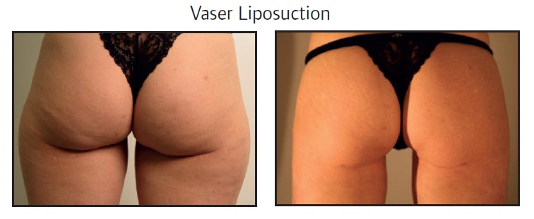 Vaser Liposuction