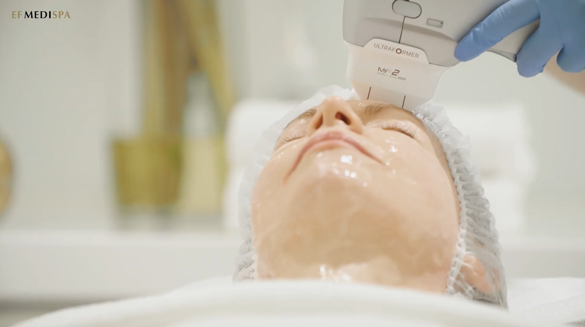 3D Skinlift by Ultraformer London