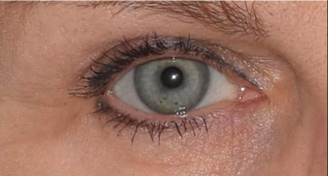 After anti-wrinkle injections