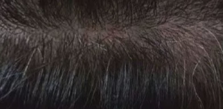 Dermastamp Hair Complex After