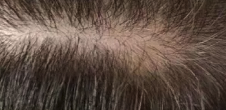 Dermastamp Hair Complex Before