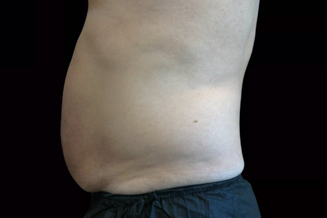 Before Emsculpt London