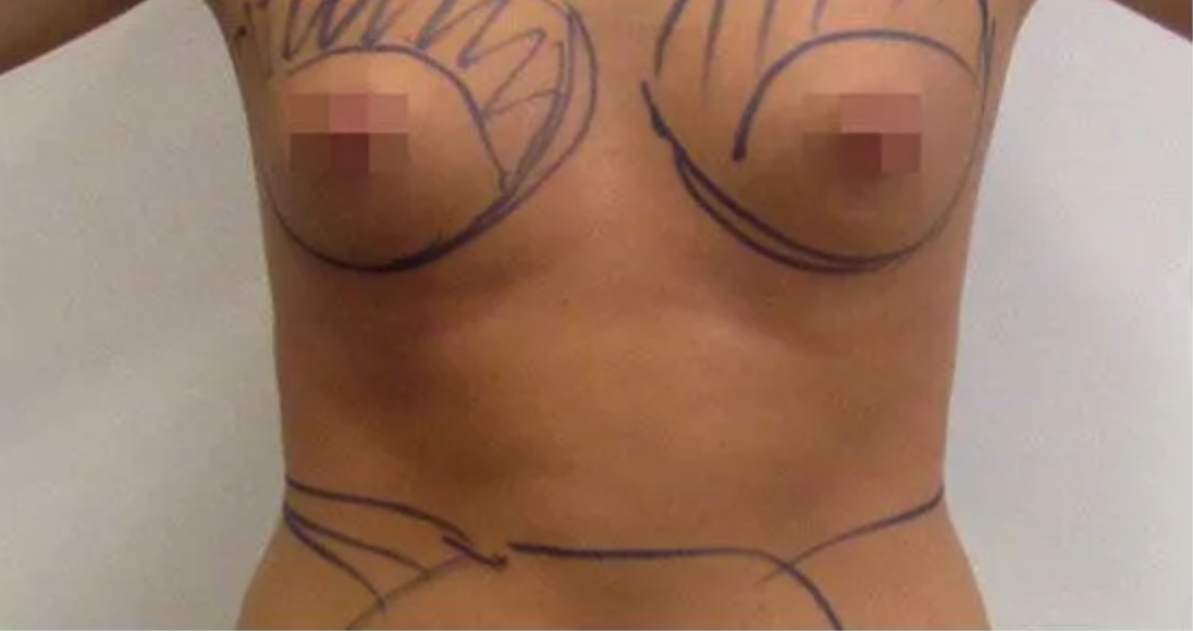 Before Fat Transfer to Breast