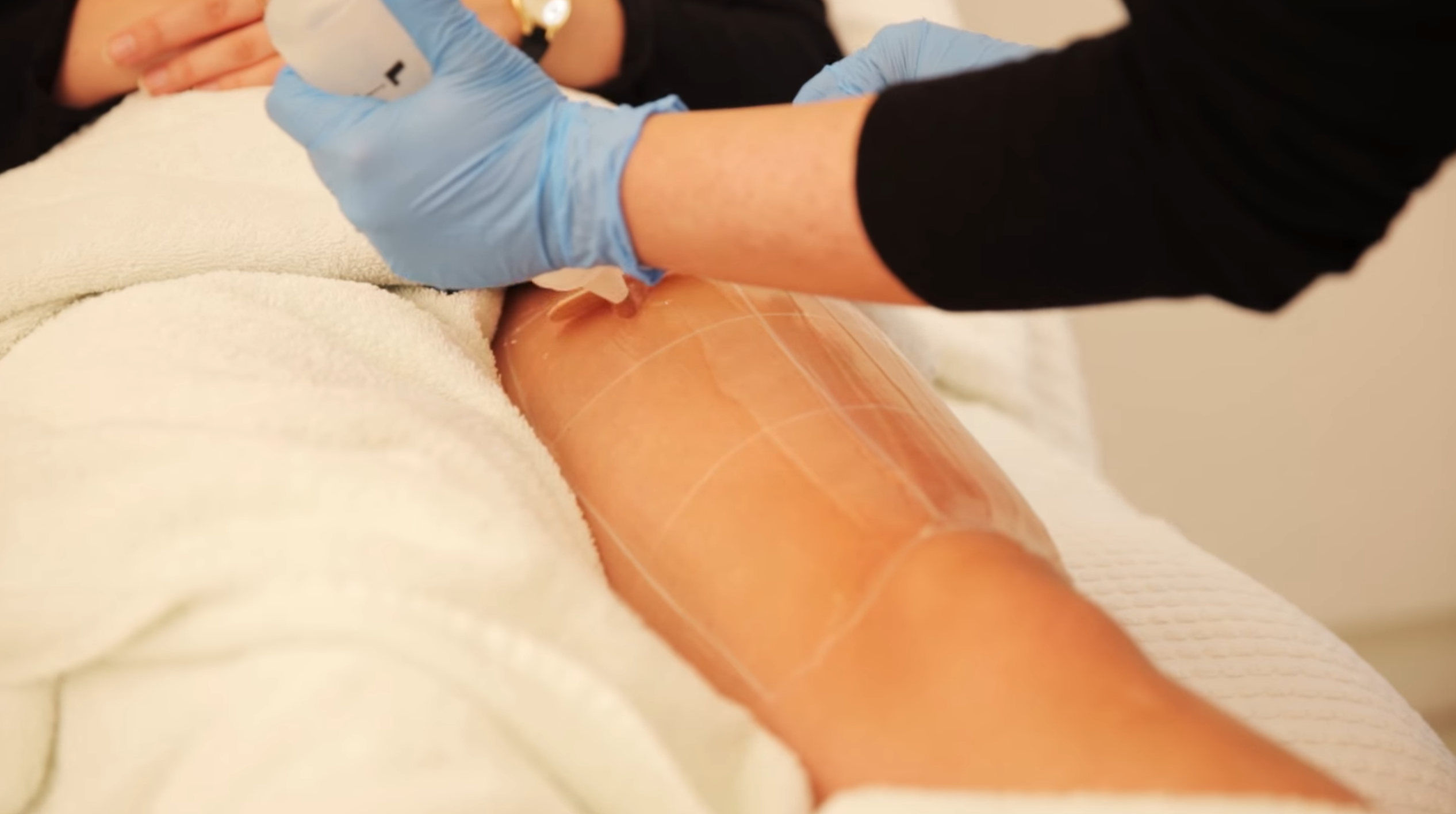 Laser Hair Removal London