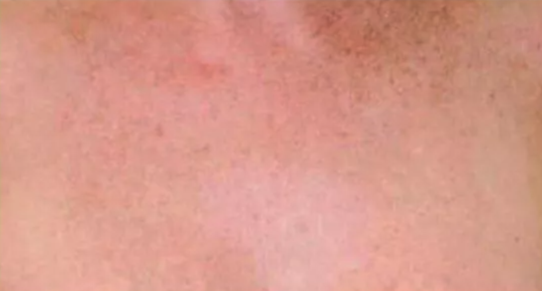 After Pixel Laser Treatment