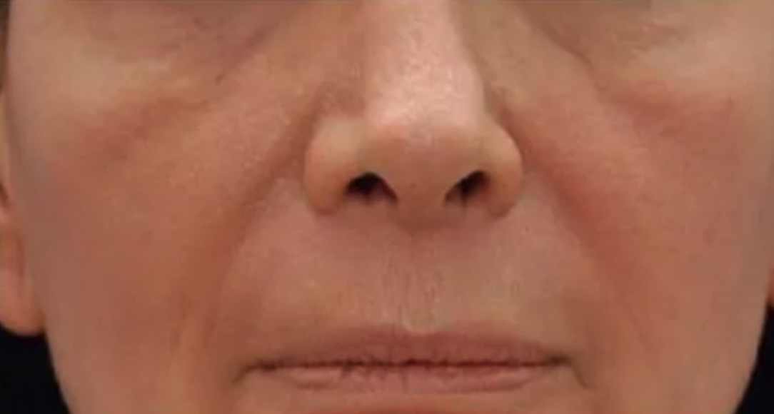 After Pixel Laser Treatment