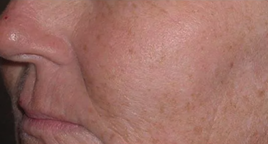 Before Fraxel Laser Treatment