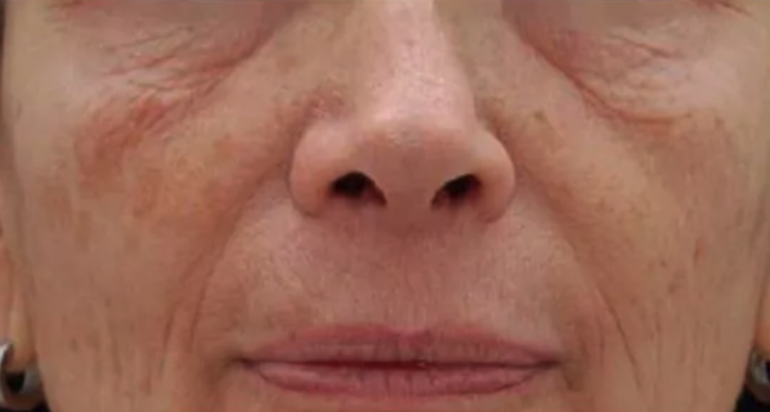 Before Pixel Laser Treatment