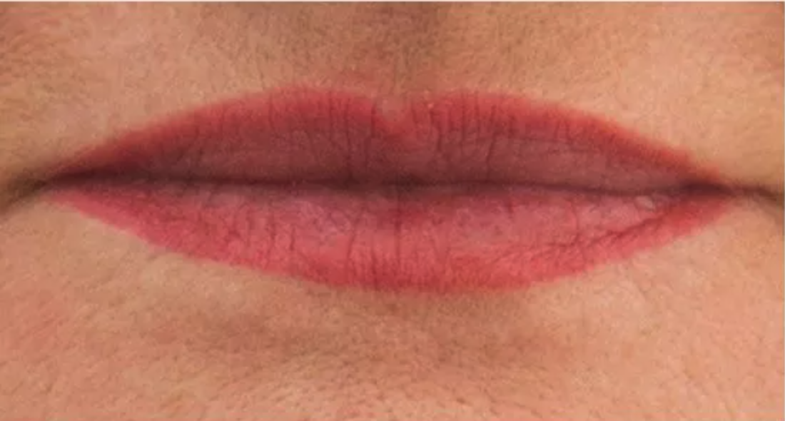 Before lip fillers