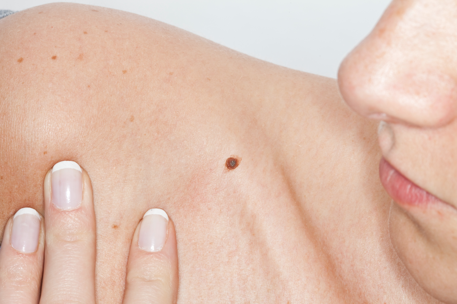 Cosmetic mole removal in London