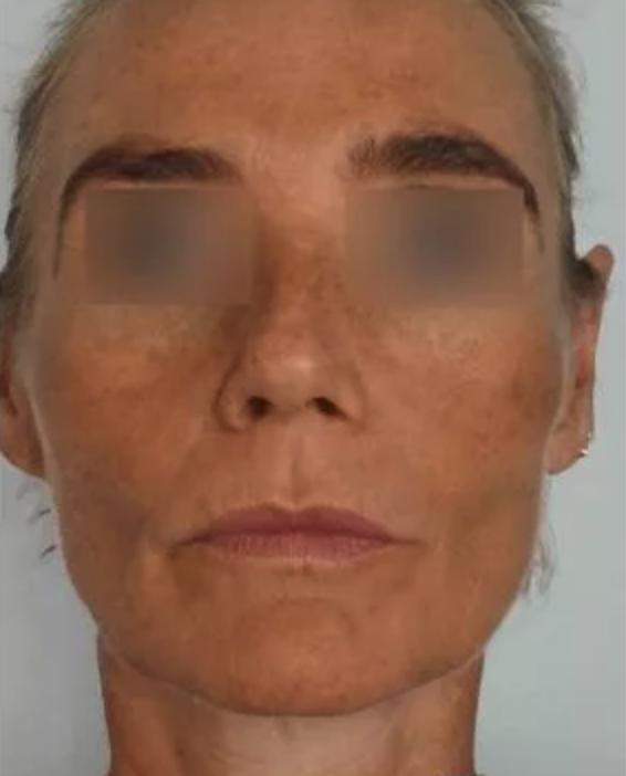 Before Profhilo London