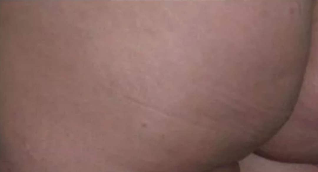 After Radiofrequency