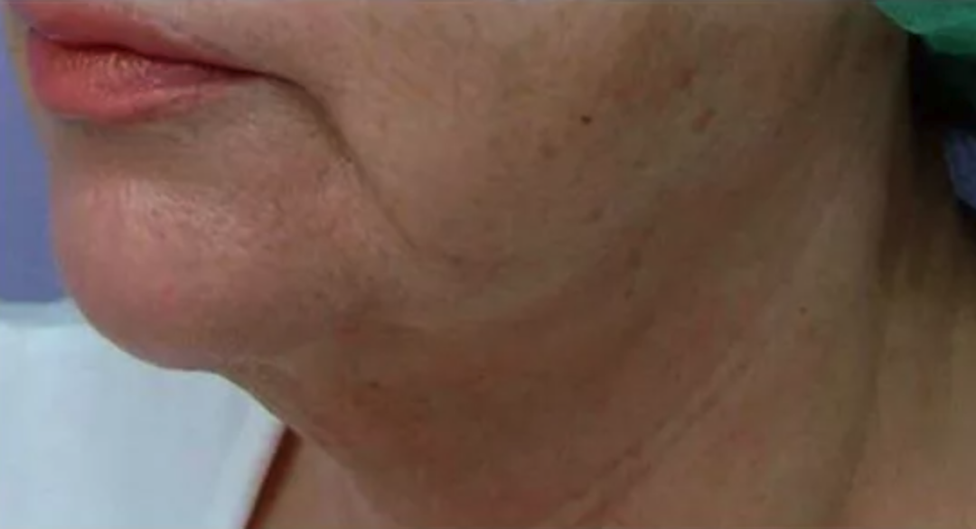 After Radiofrequency