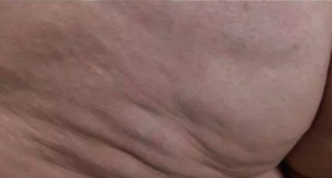 Before Radiofrequency