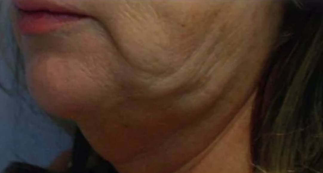 Before Radiofrequency