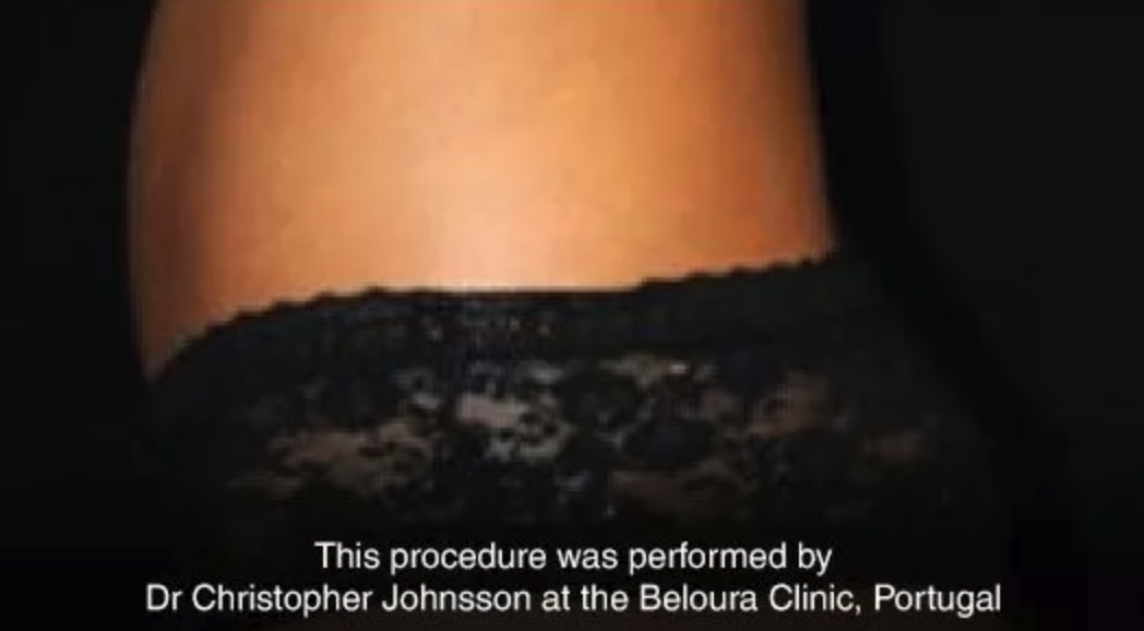 After Vaser Liposuction