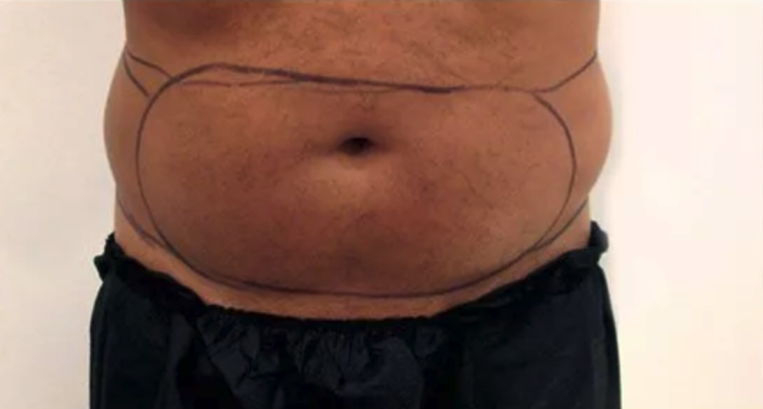 Before Vaser Liposuction